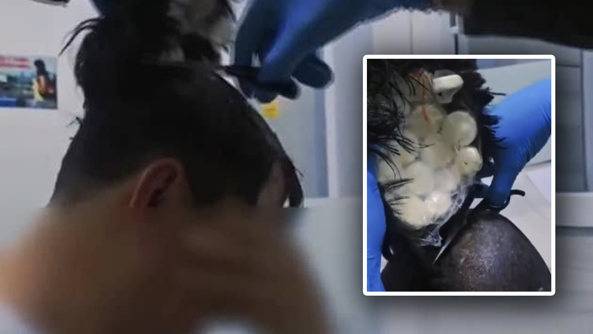 Colombian man caught smuggling cocaine under wig - Brigada News